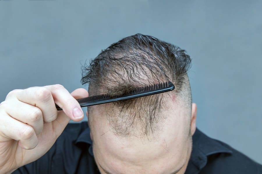Diffuser Haarverlust beim Mann