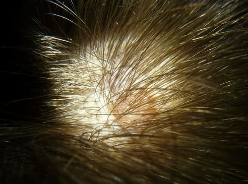 Juckende Kopfhaut nach der Haartransplantation