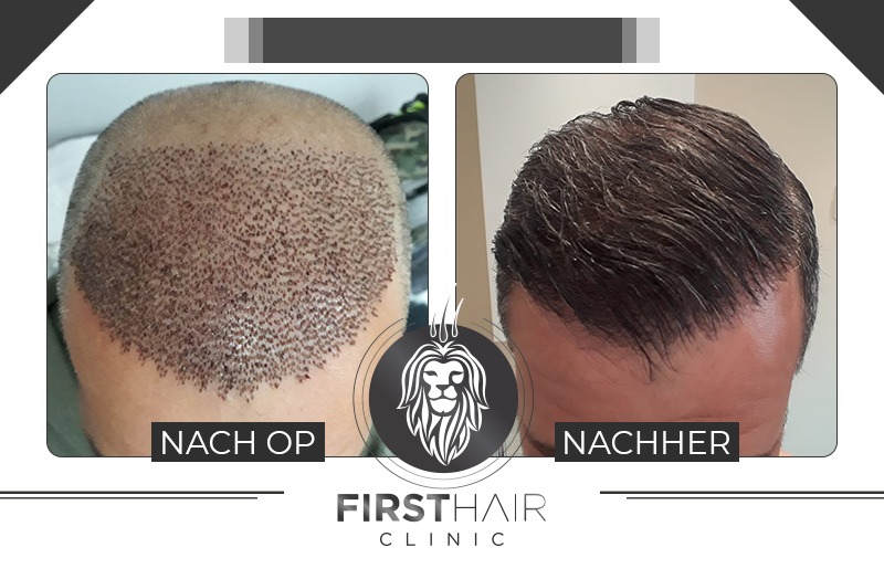 Welche Frisur Nach Haartransplantation: Ein Umfassender Leitfaden