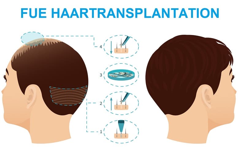 FUE Haartransplantation FUE Haartransplantation Methode