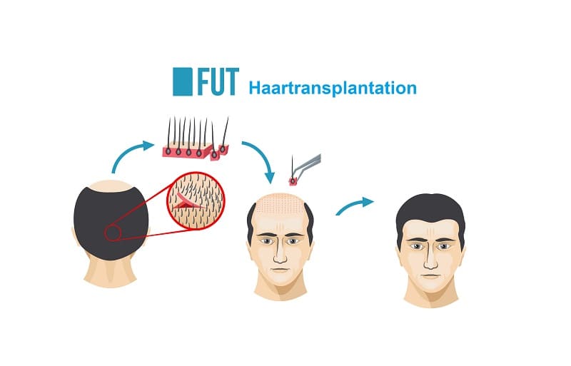 FUT Haartransplantation FUT Haartransplantation Methode