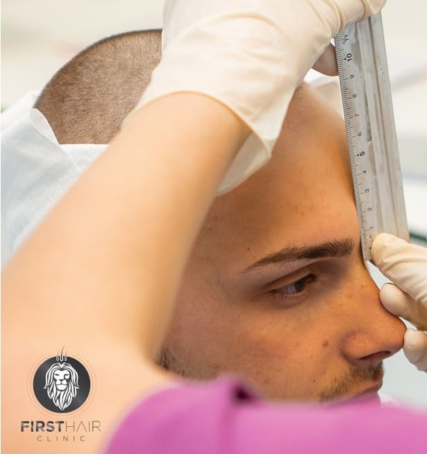 Zeichnet Haarlinie vor Haartransplantation Deutschland First Hair Clinic