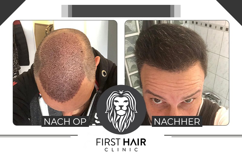 Haartransplantation Vorher Nachher Bilder First Hair Clinic