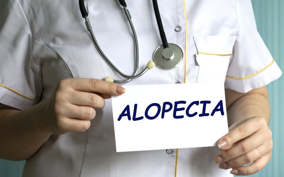 Arzt hält Karte mit der Aufschrift Alopecia in der Hand