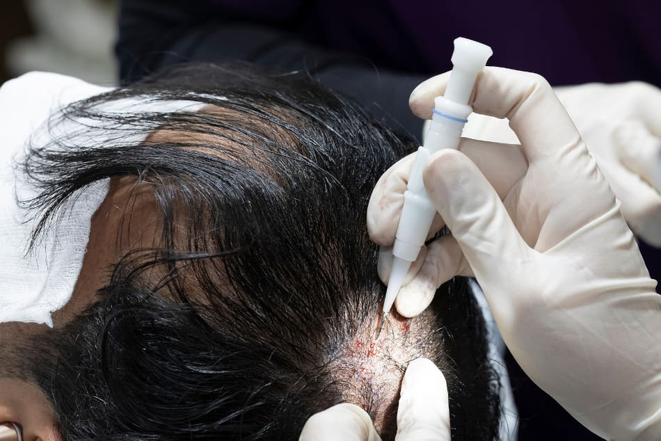 Die Haarausfall Forschung versucht die aktuellen Methoden effektiver zu machen