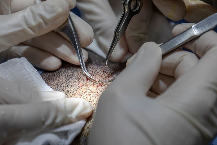 Ärzte führen Haartransplantation am Kopf eines Patienten durch