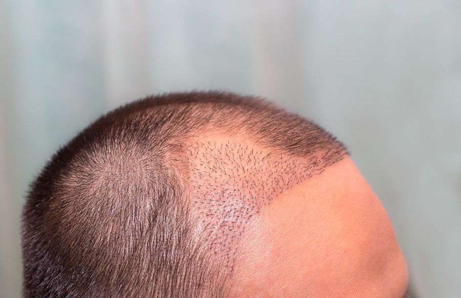 Nahaufnahme nach einer Haartransplantation um zu zeigen, wie man Infektionen verhindert