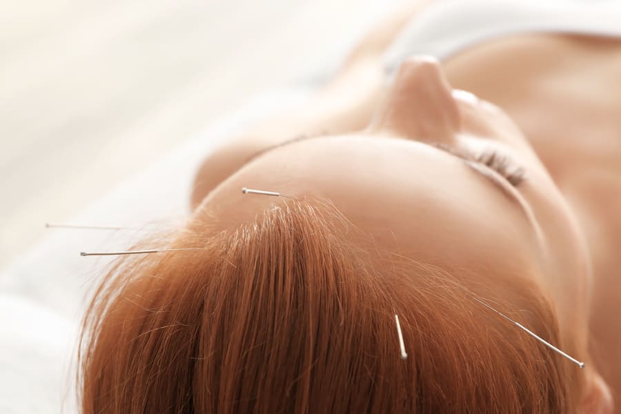 Rothaarige Frau bei einer Akupunktursitzung gegen Haarausfall