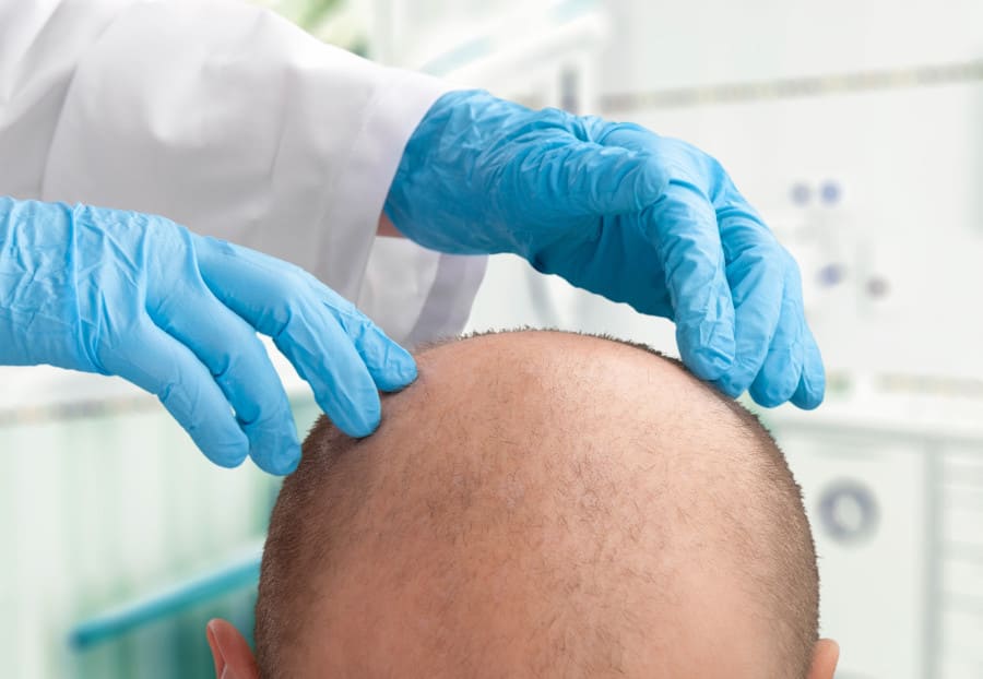 Arzt untersucht die Haare eines Patienten vor der Haartransplantation.