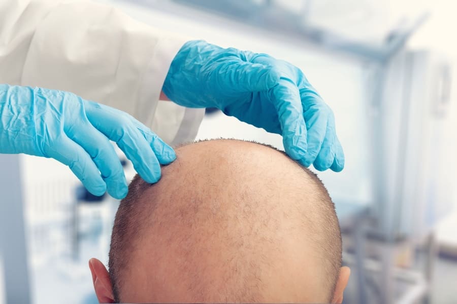 Arzt untersucht eine Halbglatze vor Haartransplantation