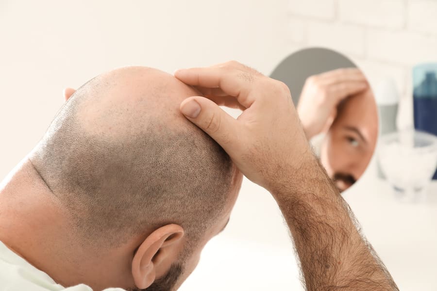 Mann denkt mit Halbglatze an Haartransplantation
