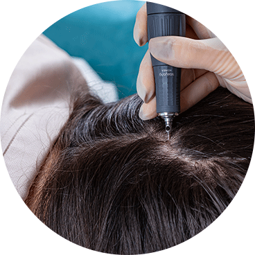 Entnahme der Grafts bei einer Patientin während der Haartransplantation für Frauen