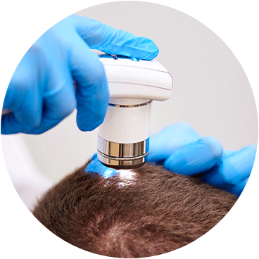 Nahaufnahme der Kontrolle der Beschaffenheit der Haare beim Patienten für die Haartransplantation in Deutschland