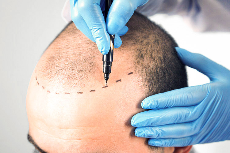 Arzt zeichnet die Haarlinie bei einem Patienten für die Saphir Haartransplantation ein