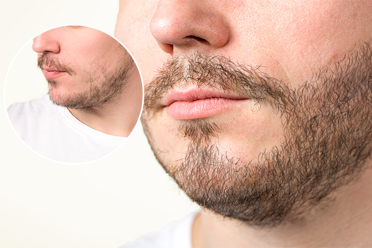 Haartransplantation Vorher Nachher Ergebnis beim Mann am Bart