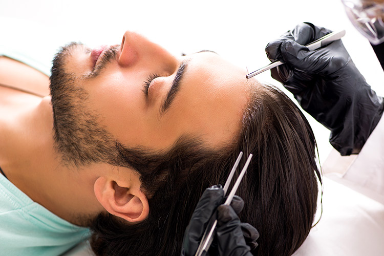 Arzt führt bei einem männlichen Patienten die FUE Haartransplantation durch