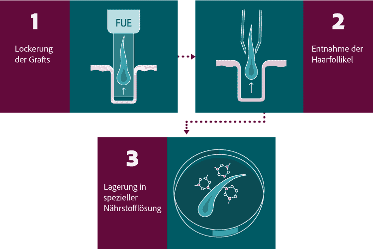 Infografik zum Ablauf der FUE Haartransplantation bei der First Hair Clinic